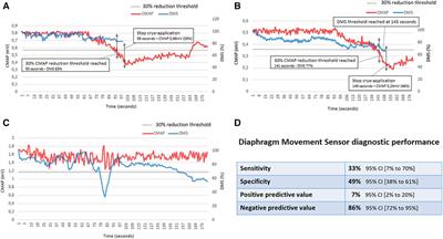 Diaphragm movement sensor for phrenic nerve monitoring during cryoballoon procedures: the first clinical evaluation
